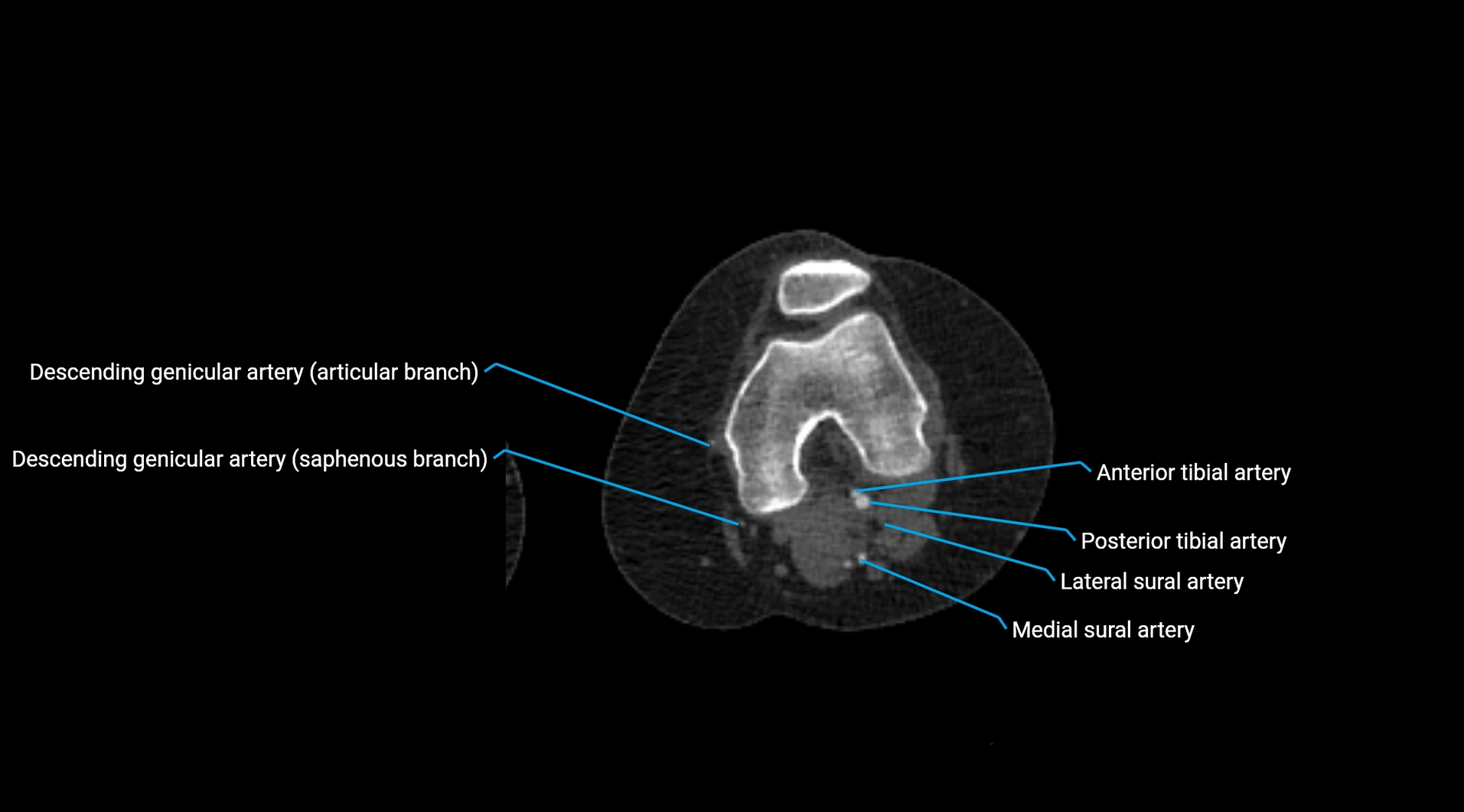 CTA lower limb cross sectional anatomy labelled image _172.webp